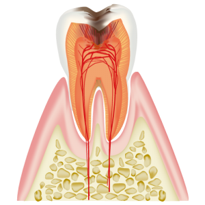 C3　神経 (歯髄)に達したむし歯