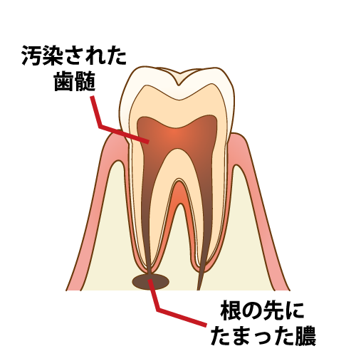 根管治療　歯髄・膿